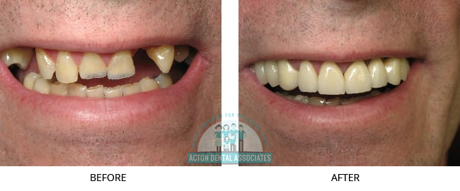 Crowns - Before and After Actual patient result image 1 at Acton Dental Associates, MA