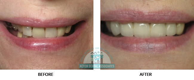 Porcelain Veneers - Before and After Actual patient result image 3 at Acton Dental Associates, MA