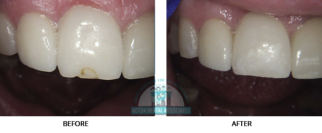 Porcelain Veneers - Case-4, Acton Dental Associates